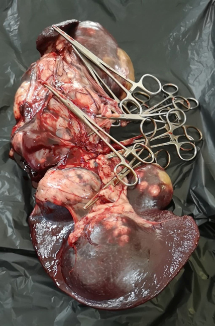 Long: histiocytoma and splenomegaly