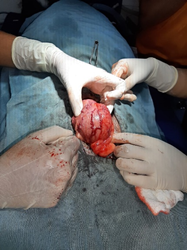 Exteriorisation of the bladder
