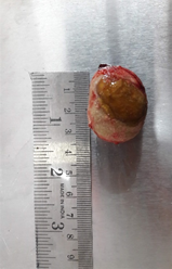 The removed cystolith, large and oval with a smooth surface